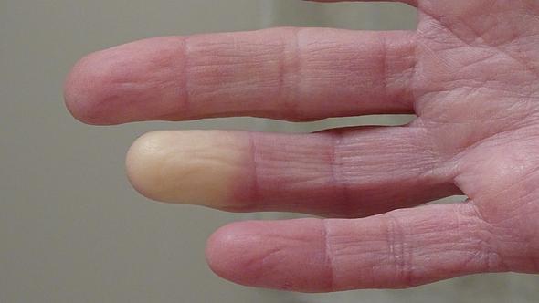Raynaud-Syndrom: Symptome der Leichenfinger sind unter anderem die blasse Farbe und Taubheit. (Themenbild) - Foto: Barb Elkin/iStock