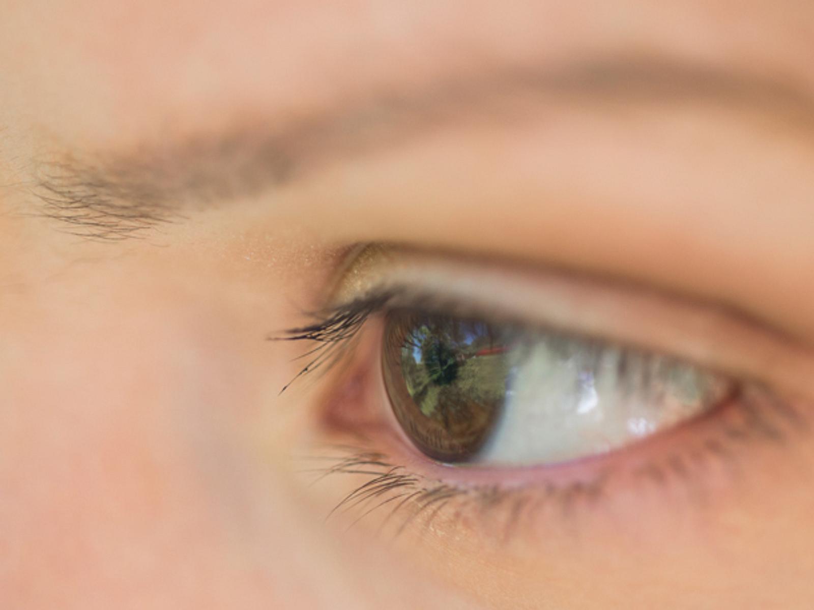 Blepharitis Wenn die Augen brennen und tränen Wunderweib