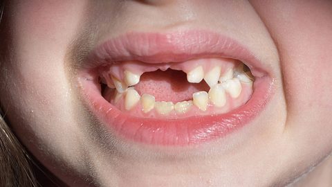 Die Pflege der Milchzähne wird gerne vernachlässigt. - Foto: iStock