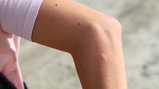 Frau hat Mückenstich am Arm - Foto: tupungato/iStock