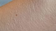 Die Nadel- oder Elektro-Epilation ist eine gute Methode zur dauerhaften Entfernung von hellen und weißen Haaren. - Foto: Wunderweib.de