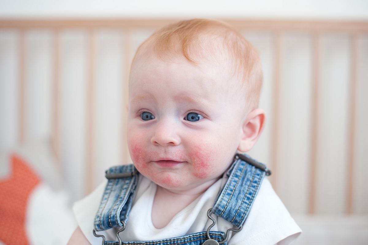 Bei Kindern ist ein typisches Neurodermitis-Symptom das Auftreten der Ekzeme im Gesicht. (Symbolbild)