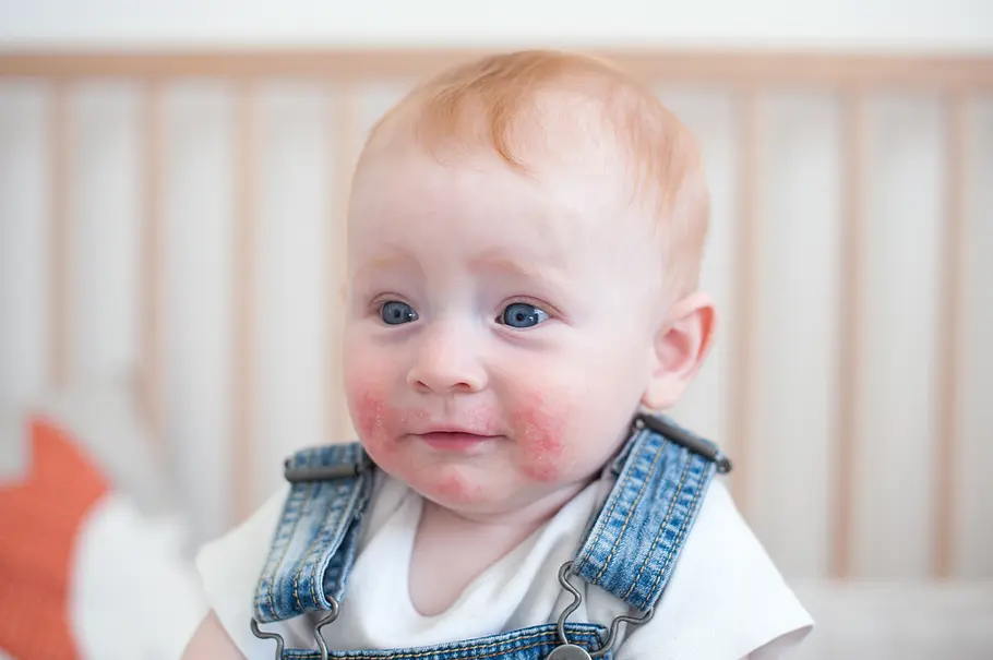 Bei Kindern ist ein typisches Neurodermitis-Symptom das Auftreten der Ekzeme im Gesicht. (Symbolbild) Bei Kindern ist ein typisches Neurodermitis-Symptom das Auftreten der Ekzeme im Gesicht. (Symbolbild)