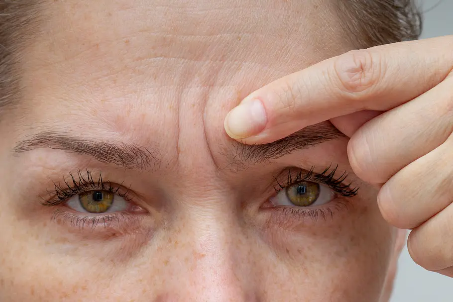 Pflaster Zornesfalte Nahaufnahme von Augen und Stirn einer Frau, sie zeigt auf ihre Zornesfalte