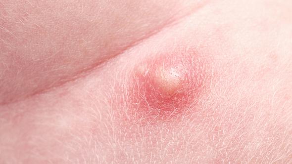 Pickel am Po: Ursachen und was du dagegen tun kannst laut Dermatologen (Themenbild) - Foto: happyfoto/iStock