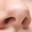 Pickel in der Nase: Was tun und was sind die Ursachen? (Themenbild) - Foto: RusN/iStock