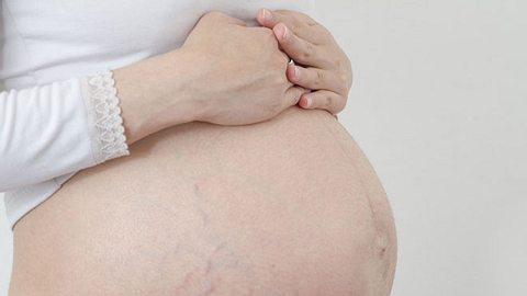 Polymorphe Schwangerschaftsdermatose: Wenn Dehnungsstreifen schmerzhaft werden - Foto: iStock