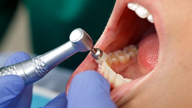 Professionelle Zahnreinigung bei einer Frau - Foto: Ocskaymark/iStock