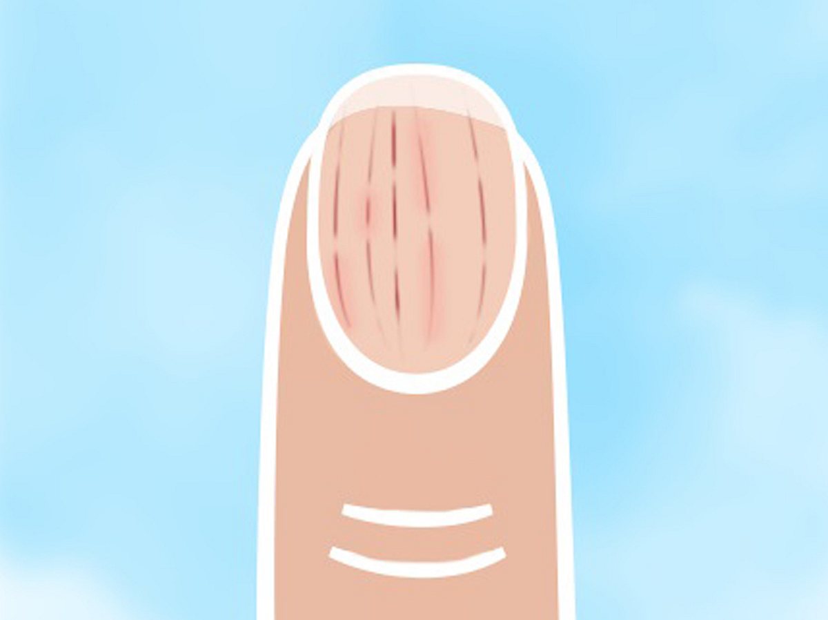 Nach einer Verletzung sehen deine Nägel so aus.