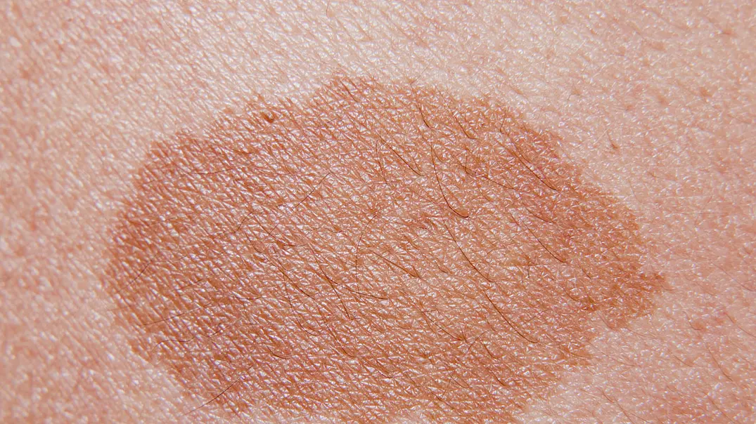 Ein Melasma ist eine Form der Hyperpigmentierung. - Foto: iStock Ein Melasma ist eine Form der Hyperpigmentierung. - Foto: iStock