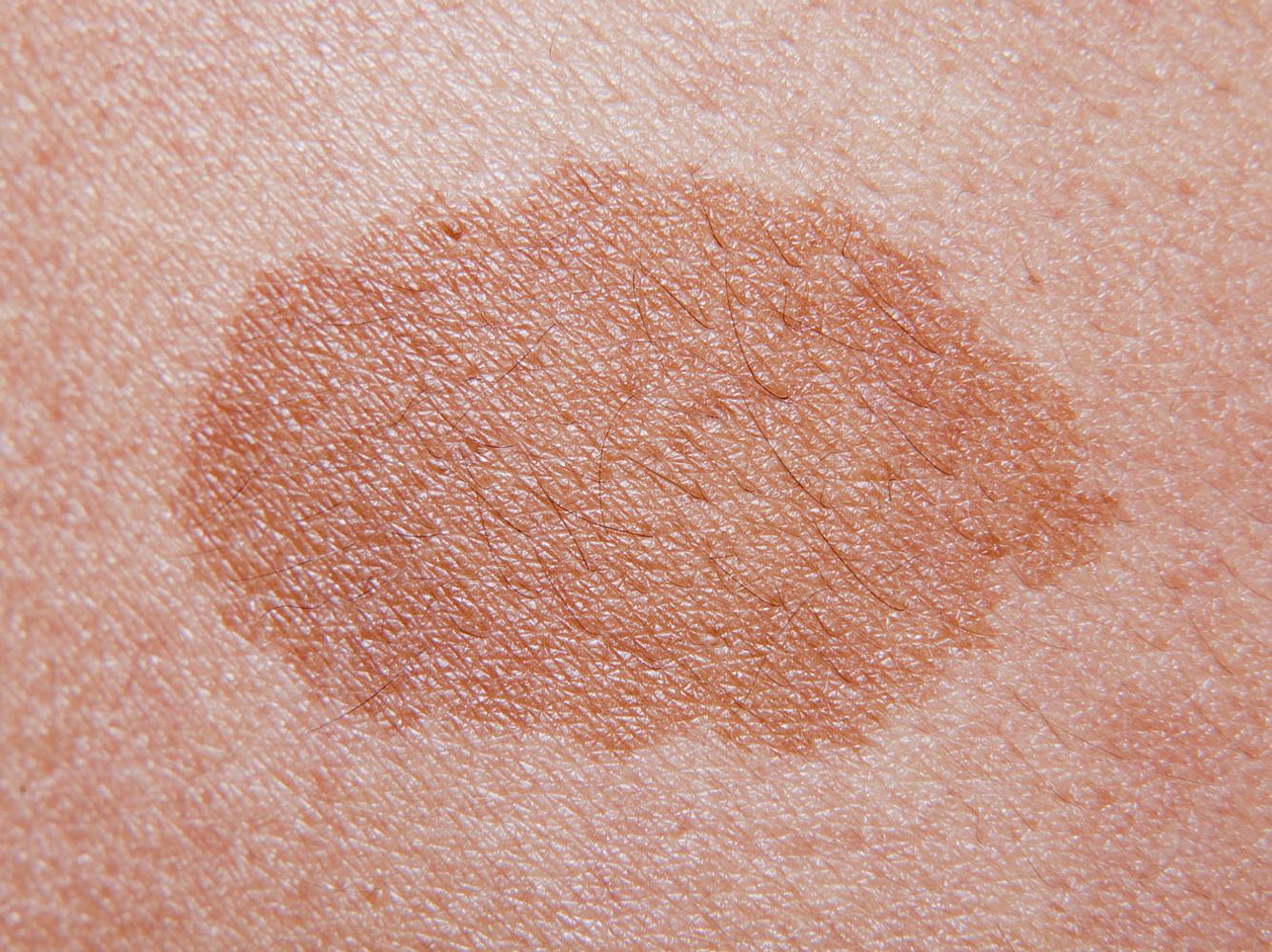 Ein Melasma ist eine Form der Hyperpigmentierung. Ein Melasma ist eine Form der Hyperpigmentierung.