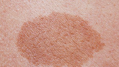 Ein Melasma ist eine Form der Hyperpigmentierung. - Foto: iStock