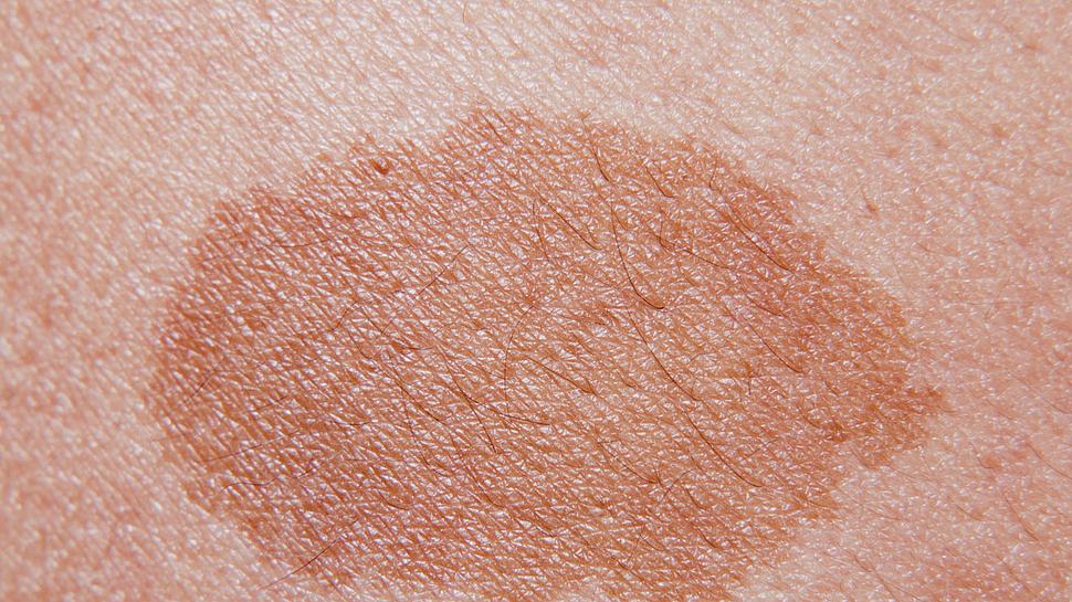 Ein Melasma ist eine Form der Hyperpigmentierung. - Foto: iStock