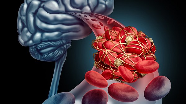 Sinusvenenthrombose: Symptome der Thrombose im Kopf sind u.a. starke und anhaltende Kopfschmerzen - Foto: wildpixel/iStock