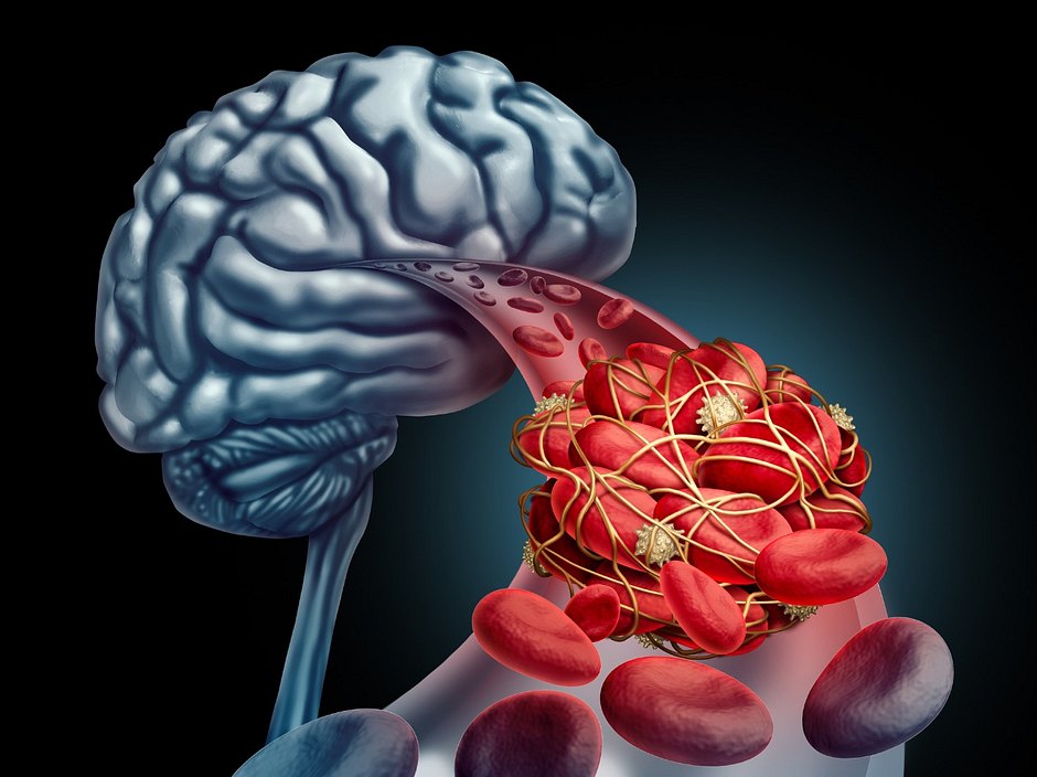 Sinusvenenthrombose: So entsteht die Thrombose im Kopf | Wunderweib