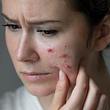 Skin Picking: Dermatillomanie nennt sich das zwanghafte Bearbeiten der Haut. (Symbolbild) - Foto: bymuratdeniz/iStock