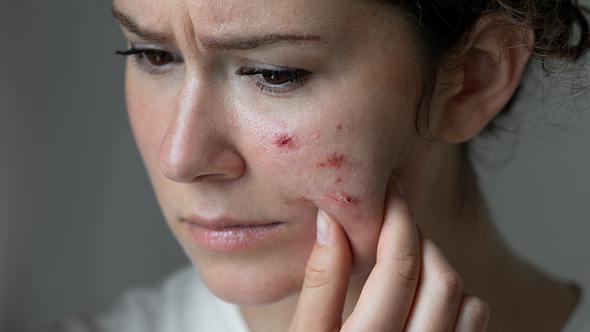 Skin Picking: Dermatillomanie nennt sich das zwanghafte Bearbeiten der Haut. (Symbolbild) - Foto: bymuratdeniz/iStock