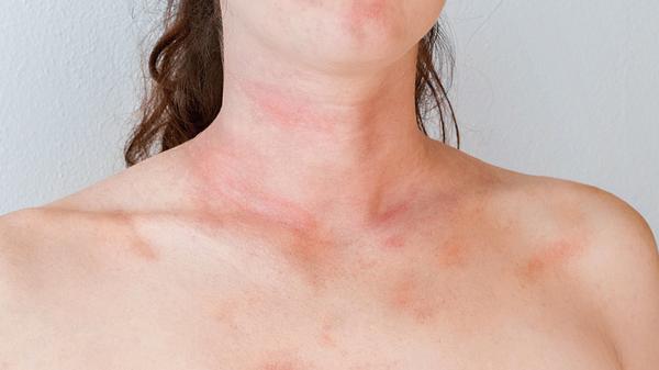 Sonnenallergie-Hausmittel helfen bei leichter polymorpher Lichtdermatose - Foto: Tunatura/iStock