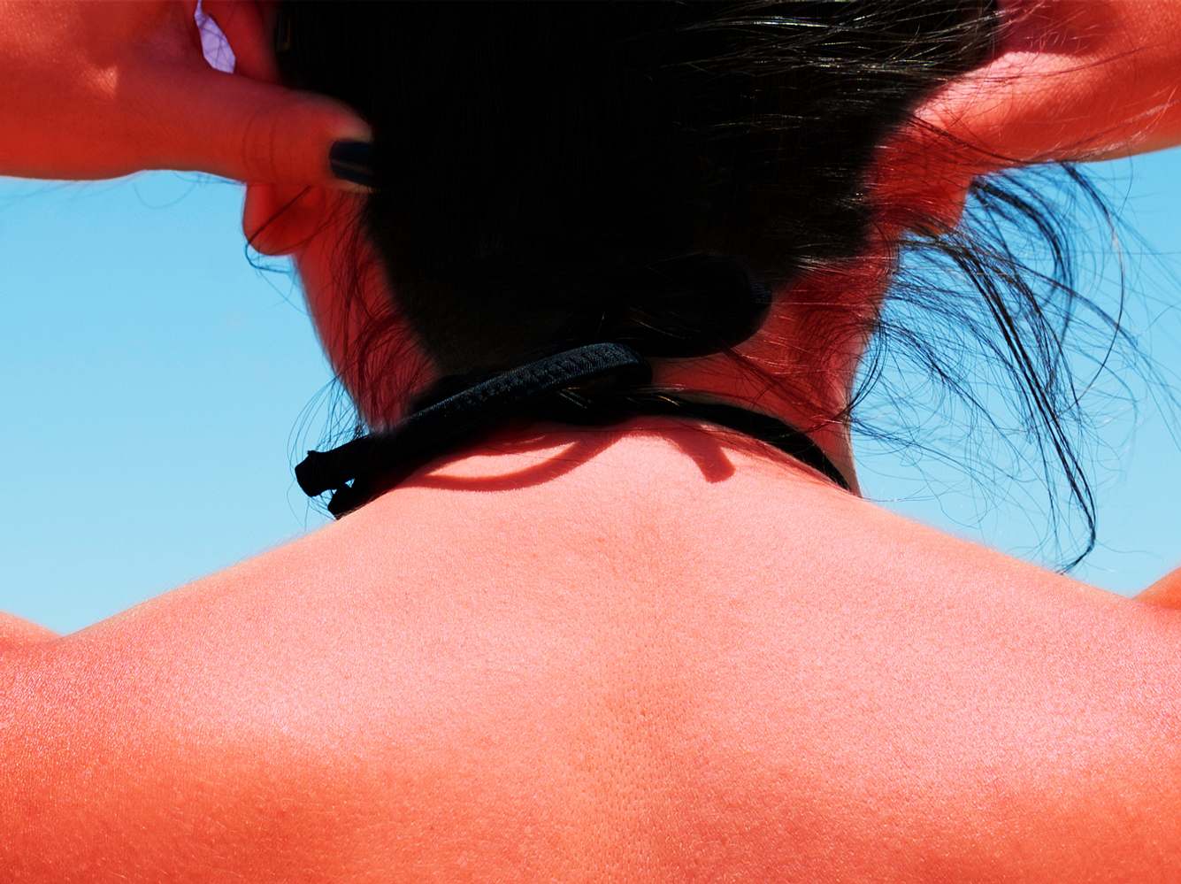 Sonnenbrand auf der Kopfhaut? Was wirklich hilft! Sonnenbrand auf der Kopfhaut? Was wirklich hilft!