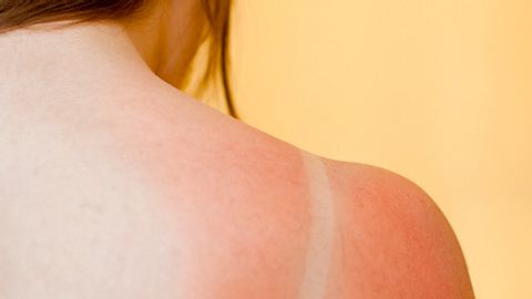 Nicht immer ist rote Haut nach der Sonne ein Sonnenbrand - Foto: Istock