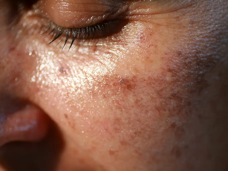Sonnencreme fürs Gesicht für reife Haut Nahaufnahme von eingecremter Haut mit leichten Augenfalten und Pigmentflecken