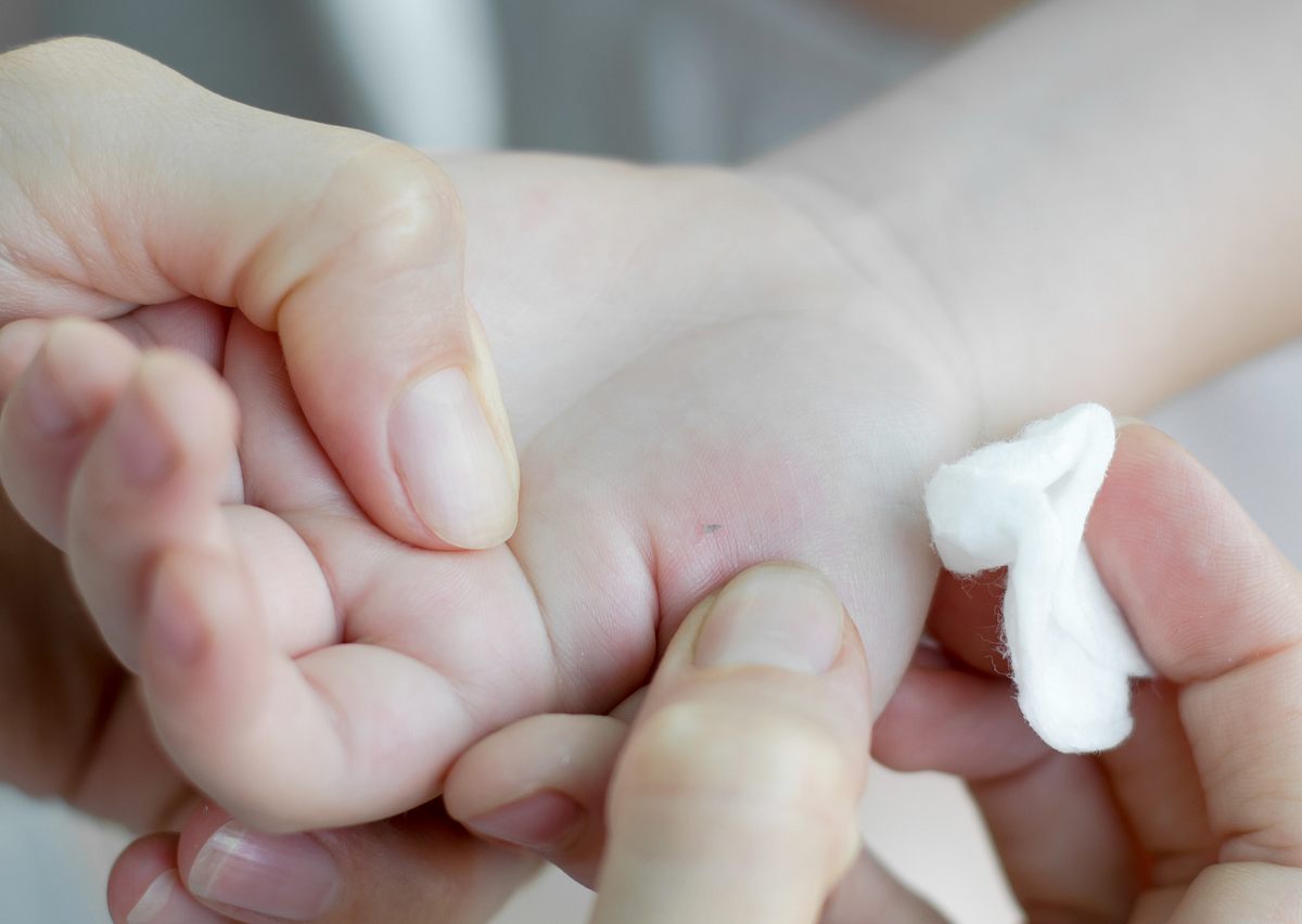 Splitter in der Hand eines Kindes wird von einer Frau desinfiziert (Themenbild)