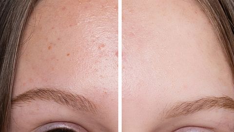 Vorher-Nachher-Vergleich: Die Stirn einer Frau links mit und rechts ohne Pigmentflecke - Foto: iStock/ MishaBeliy