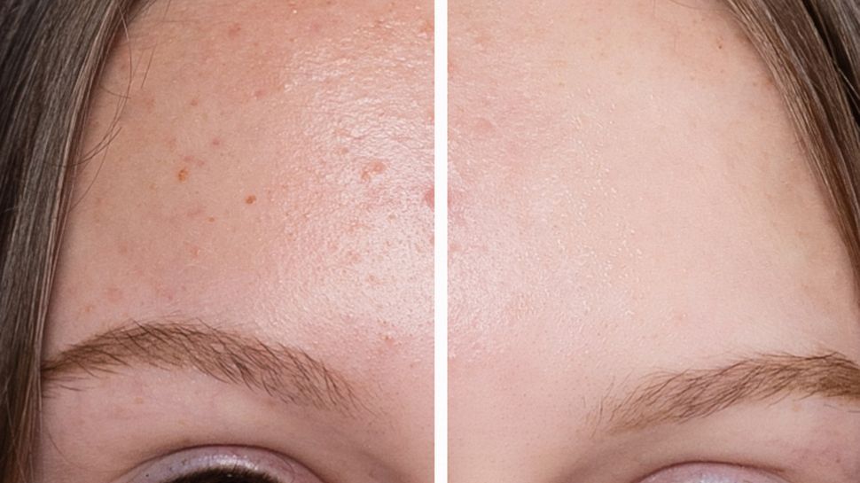 Vorher-Nachher-Vergleich: Die Stirn einer Frau links mit und rechts ohne Pigmentflecke - Foto: iStock/ MishaBeliy
