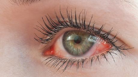 Trockene Augen: Hausmittel können bei einfachen Ursachen helfen (Themenbild) - Foto: Tunatura/iStock