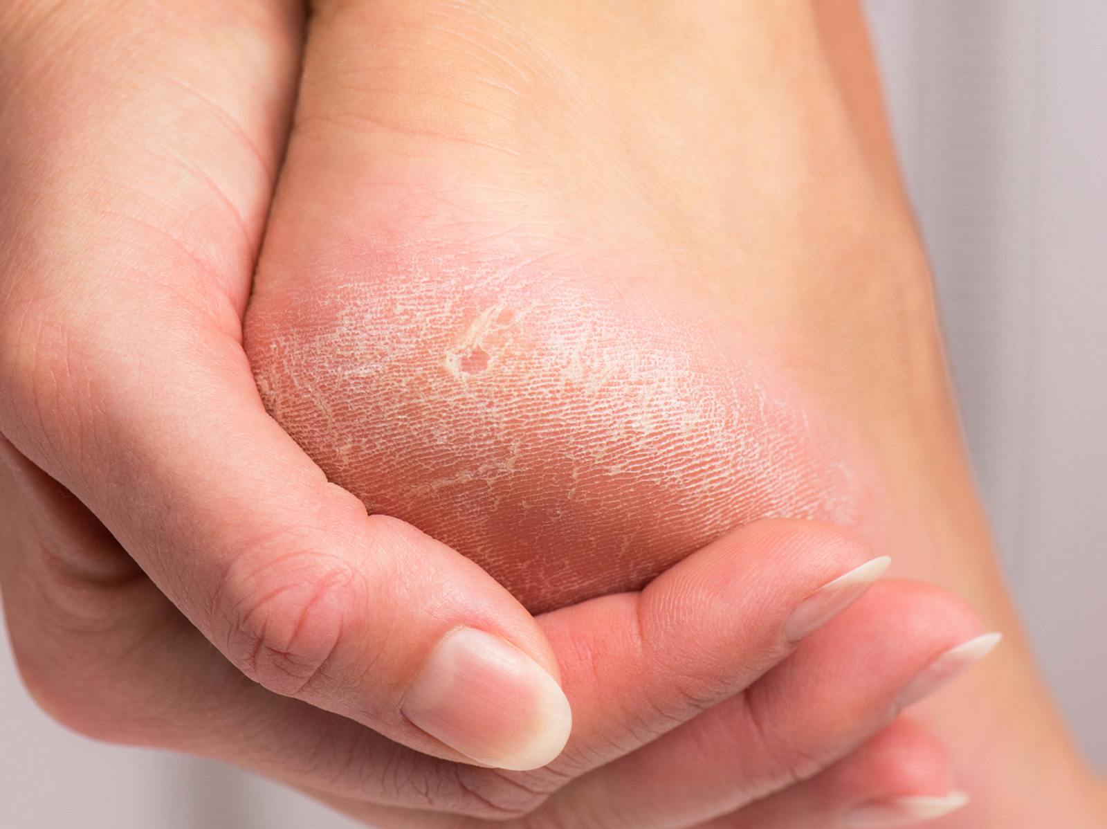 Trockene Füße: Mit diesen 4 Hausmitteln werden sie wieder weich | Wunderweib