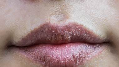 Diese Hausmittel helfen gegen trockene Lippen. - Foto: iStock/AboutnuyLove