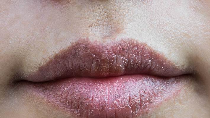 Diese Hausmittel helfen gegen trockene Lippen. - Foto: iStock/AboutnuyLove