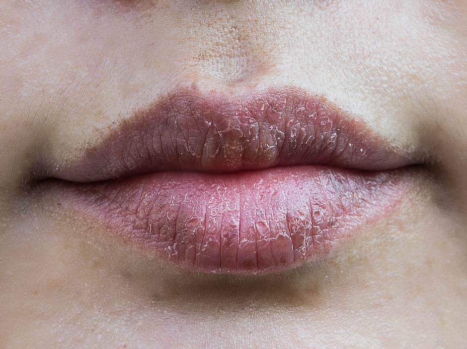 Trockene Lippen: Das sind die Gründe und diese 5 Hausmittel helfen dagegen | Wunderweib