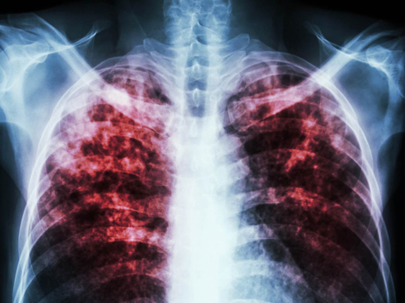 Tuberkulose ist wieder auf dem Vormarsch