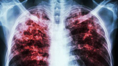Tuberkulose ist wieder auf dem Vormarsch - Foto: Istock