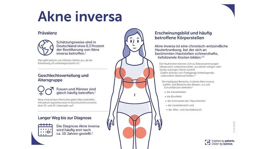 Akne inversa Akne inversa