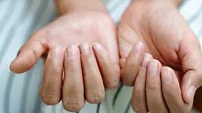 Mittel gegen verfärbte FIngernägel. - Foto: PORNCHAI SODA/iStock Mittel gegen verfärbte FIngernägel. - Foto: PORNCHAI SODA/iStock