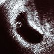 Verheimlichte Schwangerschaft: Viele Frauen entscheiden sich dafür, eine Fehlgeburt zu verschweigen. - Foto: iStock