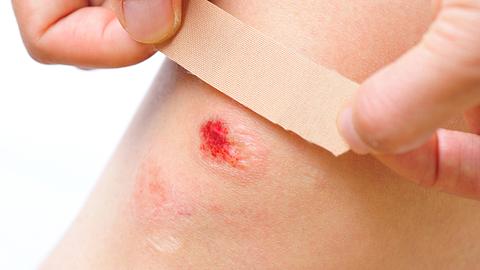 Mit unseren Tipps kannst du die Wundheilung beschleunigen. - Foto: iStock/lzf