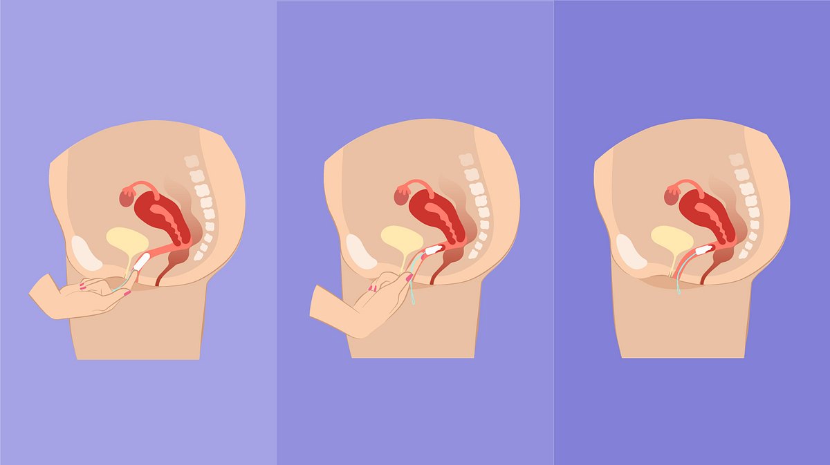 Diese Anleitung erklärt dir, wie du einen Tampon ohne Einführhilfe korrekt benutzt.