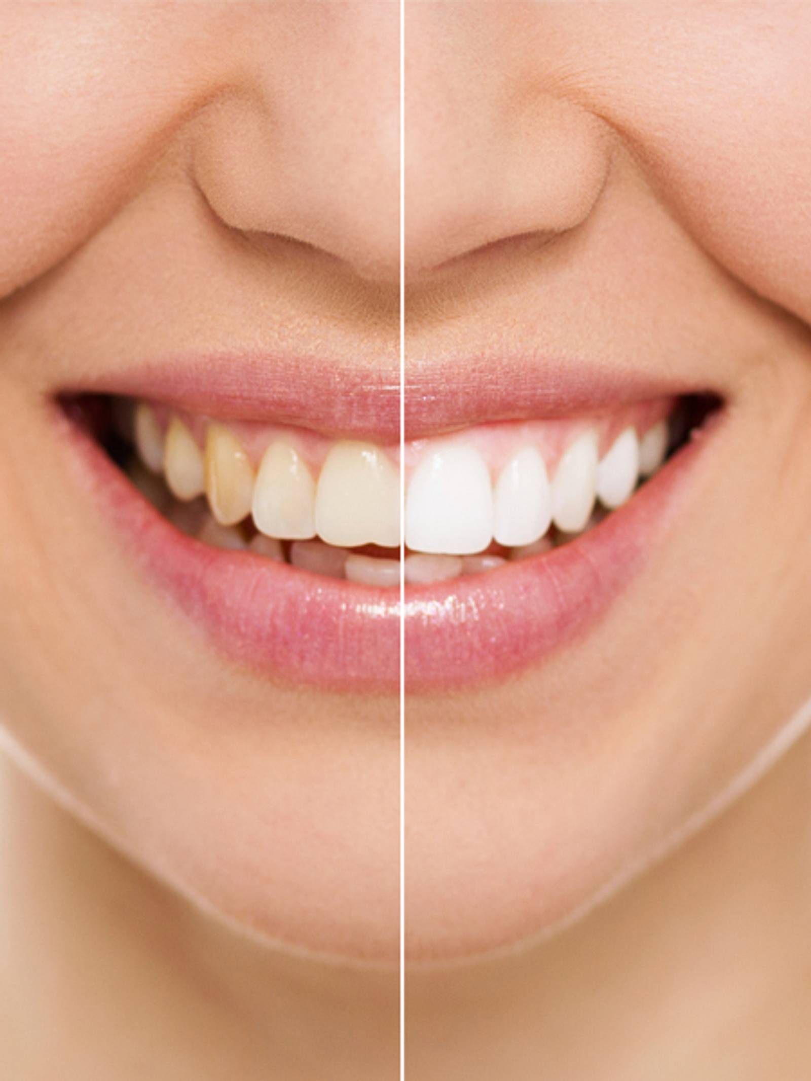 Weiß zähne bekommen wieder Zahnverfärbungen: Was