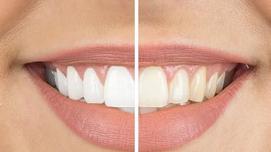 Zähne natürlich aufhellen - Foto: iStock/ bymuratdeniz 