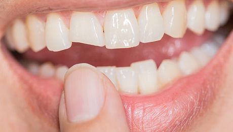 Zahn abgebrochen: Jetzt ist schnelle Hilfe gefragt. (Symbolbild) - Foto: coffeekai/iStock