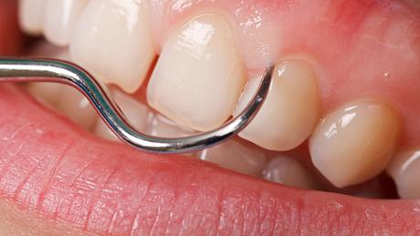 Zahnfleischtaschen deuten auf eine Zahnfleischentzündung hin. - Foto: iStock/Obencem