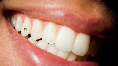 Schöne Zähne werden nun zusätzlich mit Zahnschmuck geschmückt. - Foto: iStock/danielzgombic