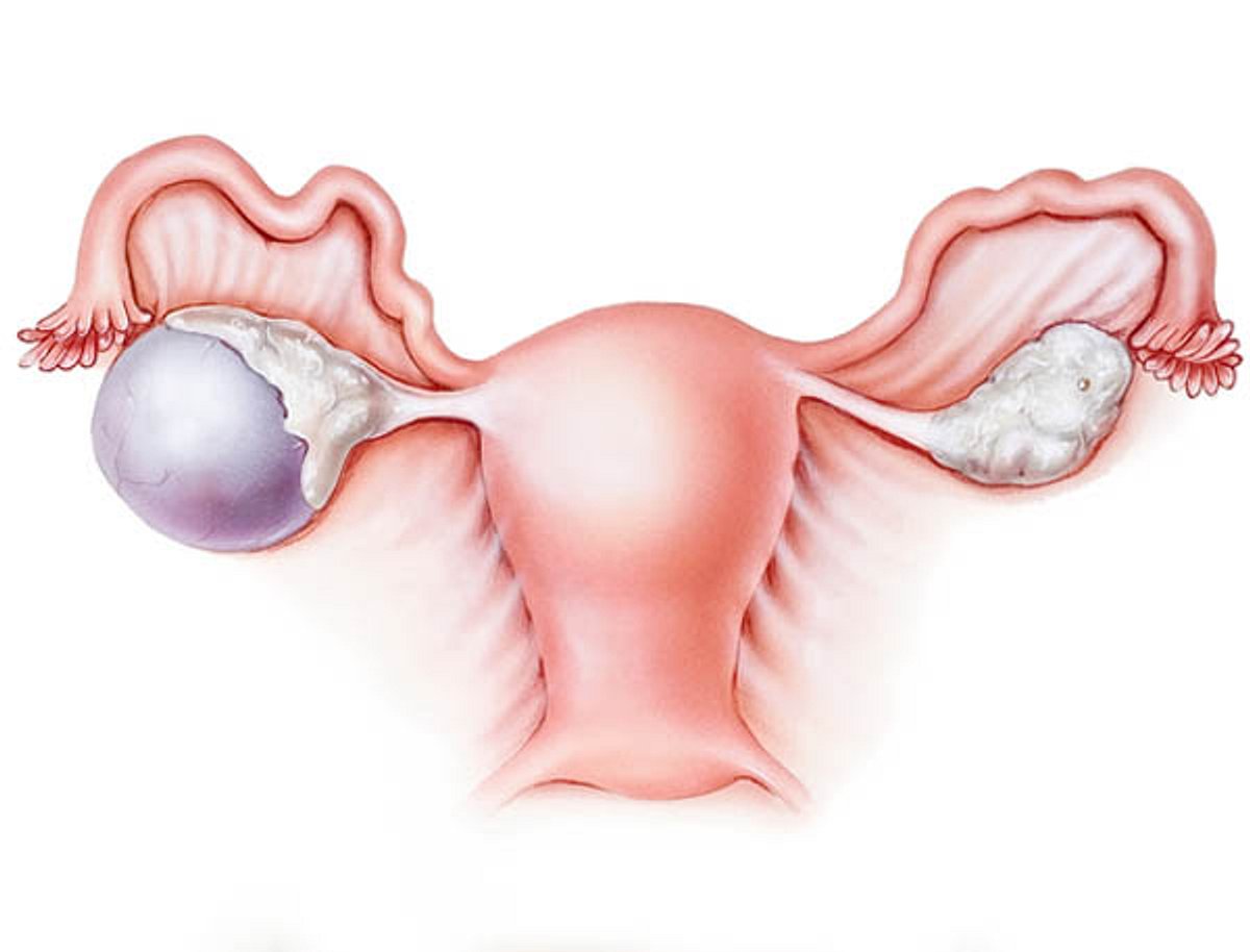 Zysten an den Eierstöcken treten meist bei Frauen im fruchtbaren Alter auf.